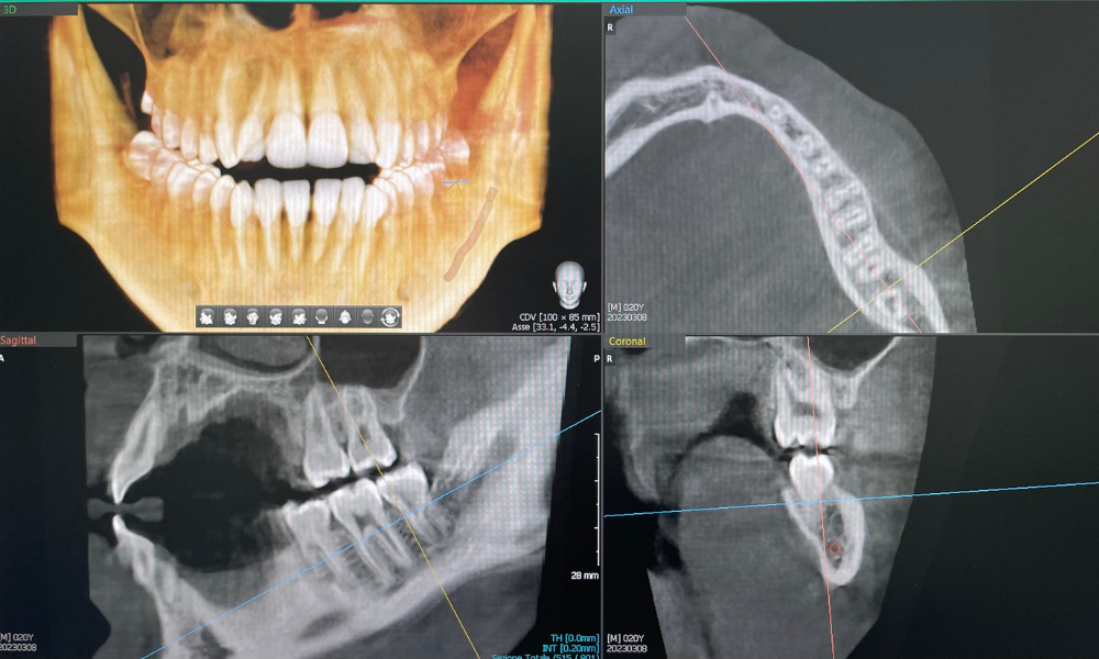 Pianificazione digitale implantare: prevedibilità e sicurezza