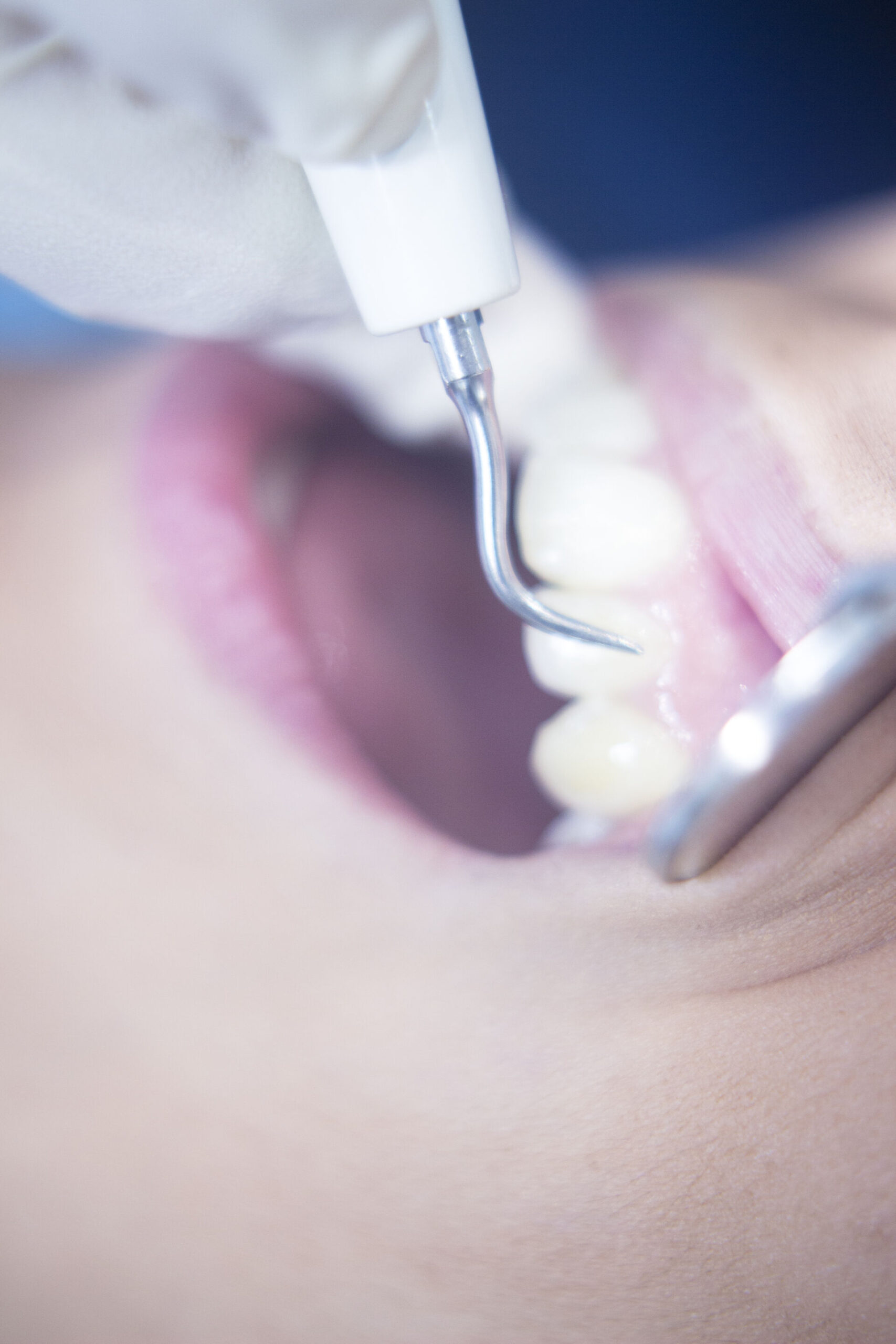 pulizia denti Torino trattamento professionale