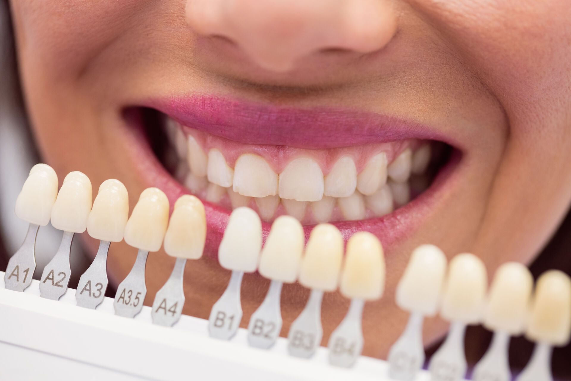 sorriso bianco Torino trattamento