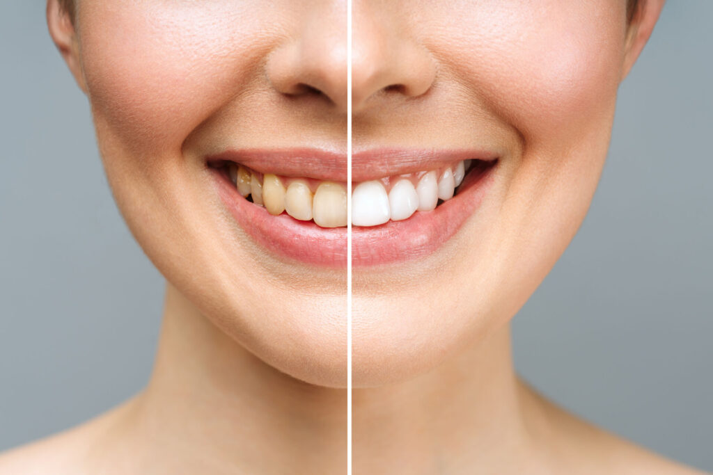 estetica dentale Torino dentista, sbiancamento prima e dopo