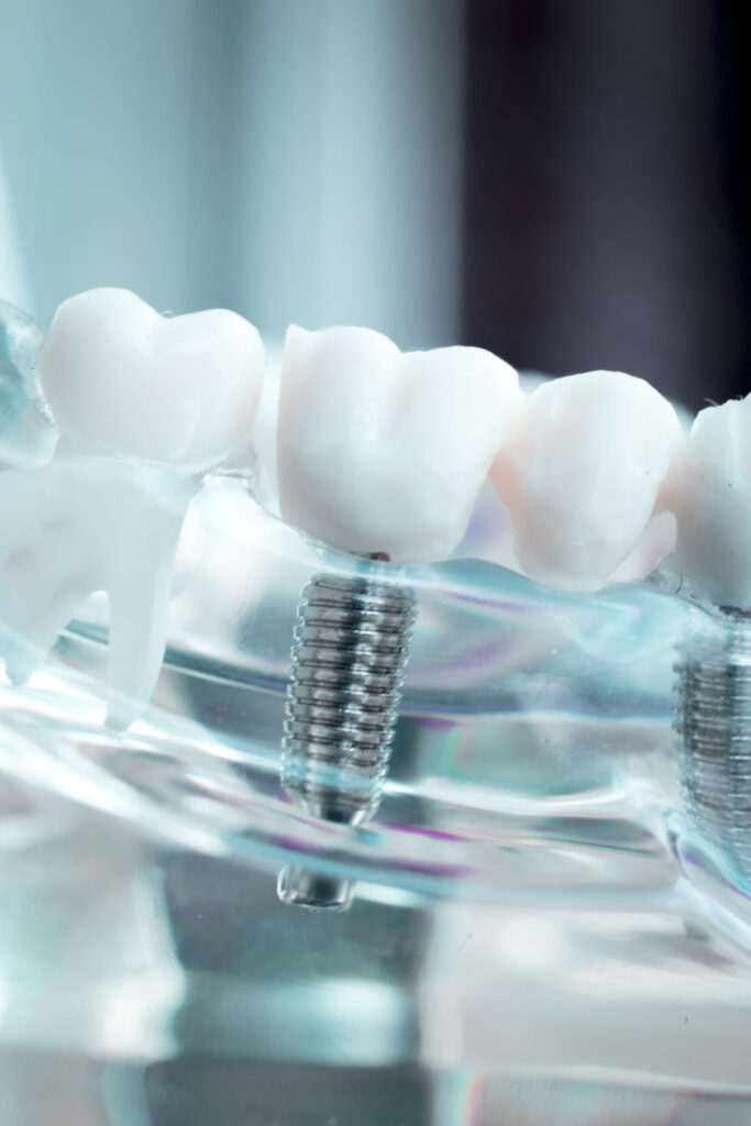 implantologia dentale Torino intervento
