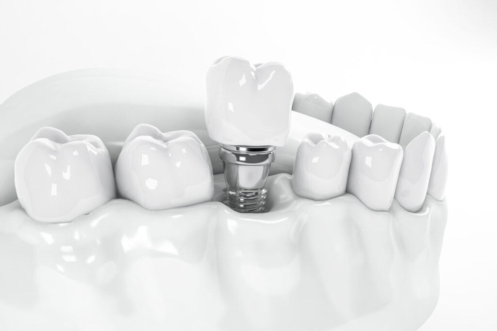 studio odontoiatrico Torino impianti denti